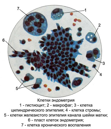 Клетки цилиндрического эпителия с дегенеративными изменениями